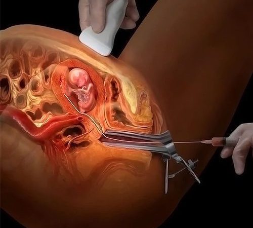 Chorionic Villous Sampling