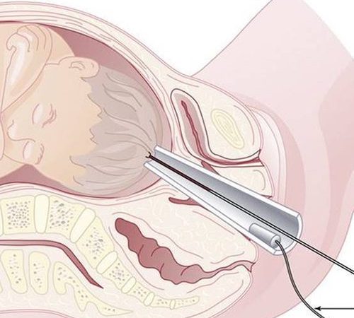 Fetal Blood Sampling